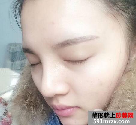 鼻综合修复术后1个多月|附上整形前后对比图