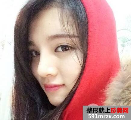 鼻综合修复术后1个多月|附上整形前后对比图