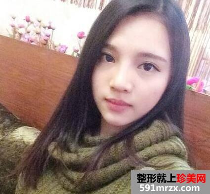 鼻综合修复术后1个多月|附上整形前后对比图
