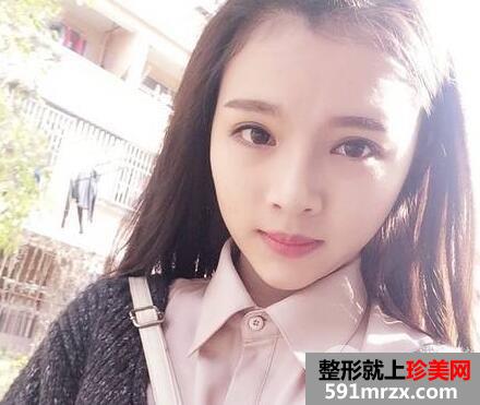 鼻综合修复术后1个多月|附上整形前后对比图