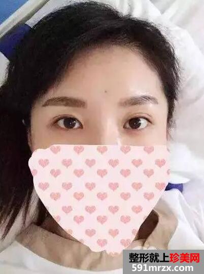双眼皮手术恢复全过程 每日恢复记录+前后效果对比图