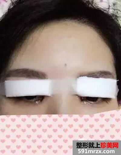 双眼皮手术恢复全过程 每日恢复记录+前后效果对比图