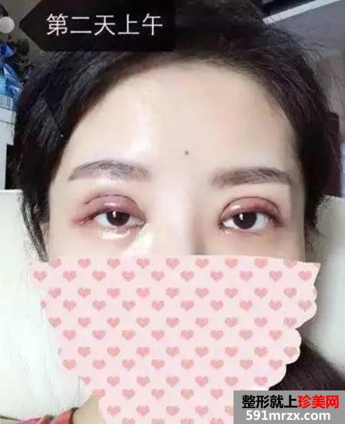 双眼皮手术恢复全过程 每日恢复记录+前后效果对比图