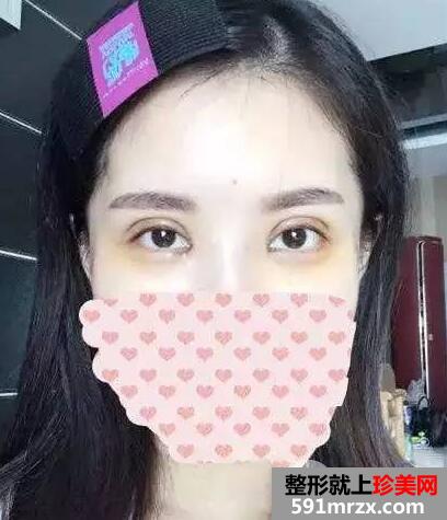 双眼皮手术恢复全过程 每日恢复记录+前后效果对比图