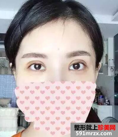 双眼皮手术恢复全过程 每日恢复记录+前后效果对比图