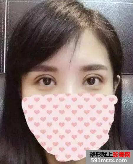 双眼皮手术恢复全过程 每日恢复记录+前后效果对比图