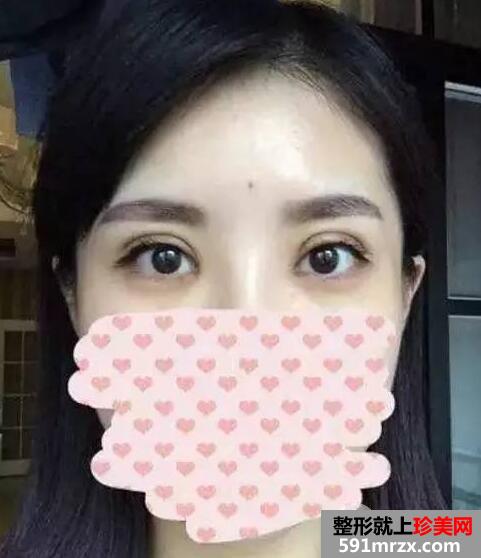 双眼皮手术恢复全过程 每日恢复记录+前后效果对比图