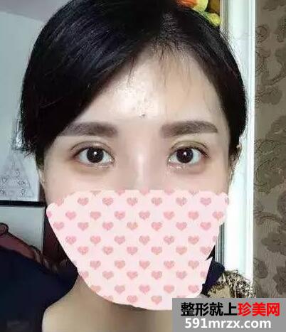 双眼皮手术恢复全过程 每日恢复记录+前后效果对比图