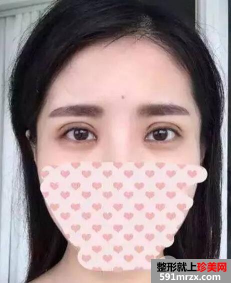 双眼皮手术恢复全过程 每日恢复记录+前后效果对比图