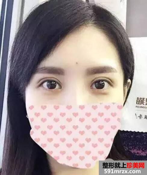 双眼皮手术恢复全过程 每日恢复记录+前后效果对比图