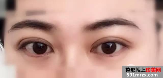 双眼皮恢复过程图 双眼皮手术前后对比照