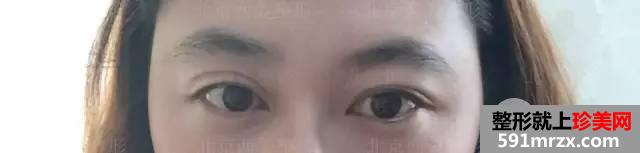 双眼皮恢复过程图 双眼皮手术前后对比照