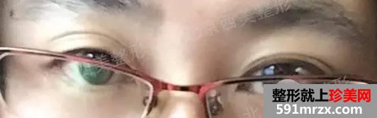 双眼皮恢复过程图 双眼皮手术前后对比照
