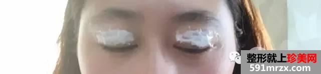 双眼皮恢复过程图 双眼皮手术前后对比照