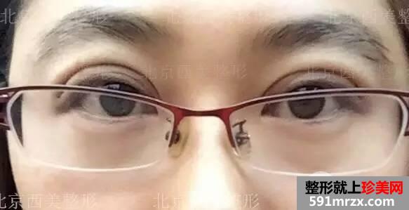 双眼皮恢复过程图 双眼皮手术前后对比照