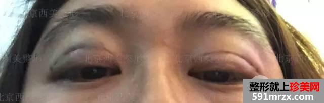 双眼皮恢复过程图 双眼皮手术前后对比照