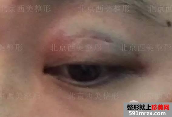 双眼皮恢复过程图 双眼皮手术前后对比照