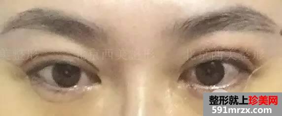 双眼皮恢复过程图 双眼皮手术前后对比照
