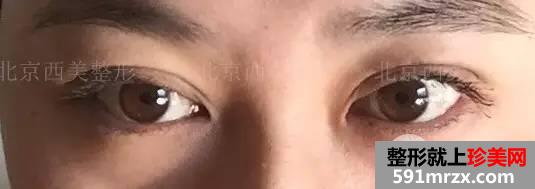 双眼皮恢复过程图 双眼皮手术前后对比照