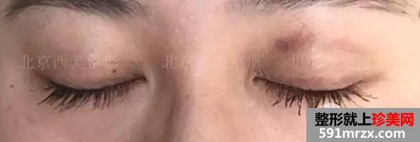 双眼皮恢复过程图 双眼皮手术前后对比照