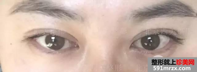 双眼皮恢复过程图 双眼皮手术前后对比照
