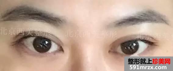 双眼皮恢复过程图 双眼皮手术前后对比照