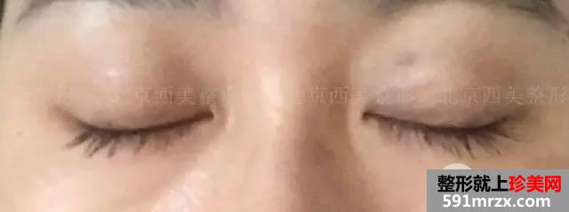 双眼皮恢复过程图 双眼皮手术前后对比照
