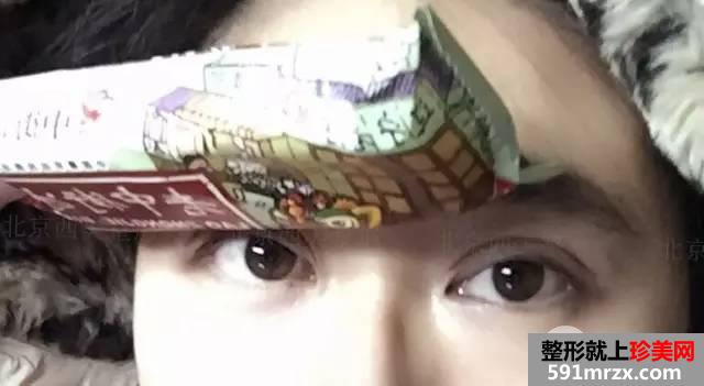 双眼皮恢复过程图 双眼皮手术前后对比照