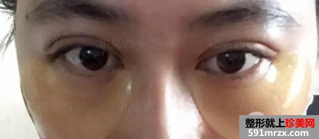 双眼皮恢复过程图 双眼皮手术前后对比照