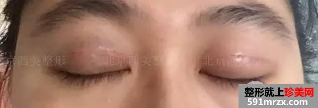 双眼皮恢复过程图 双眼皮手术前后对比照