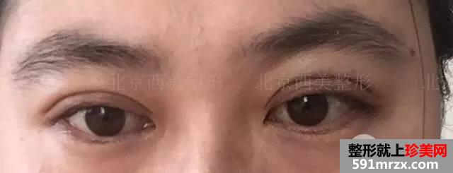 双眼皮恢复过程图 双眼皮手术前后对比照