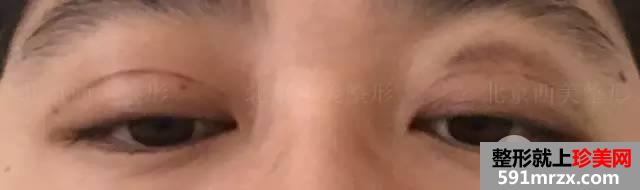 双眼皮恢复过程图 双眼皮手术前后对比照