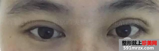 双眼皮恢复过程图 双眼皮手术前后对比照