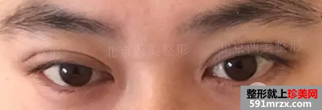 双眼皮恢复过程图 双眼皮手术前后对比照