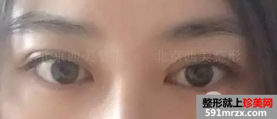 双眼皮恢复过程图 双眼皮手术前后对比照