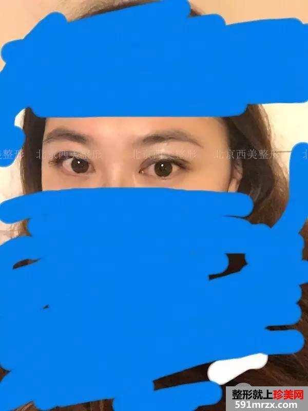 双眼皮恢复过程图 双眼皮手术前后对比照