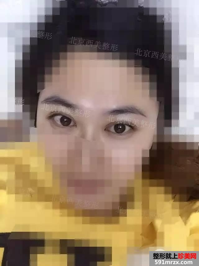 双眼皮恢复过程图 双眼皮手术前后对比照
