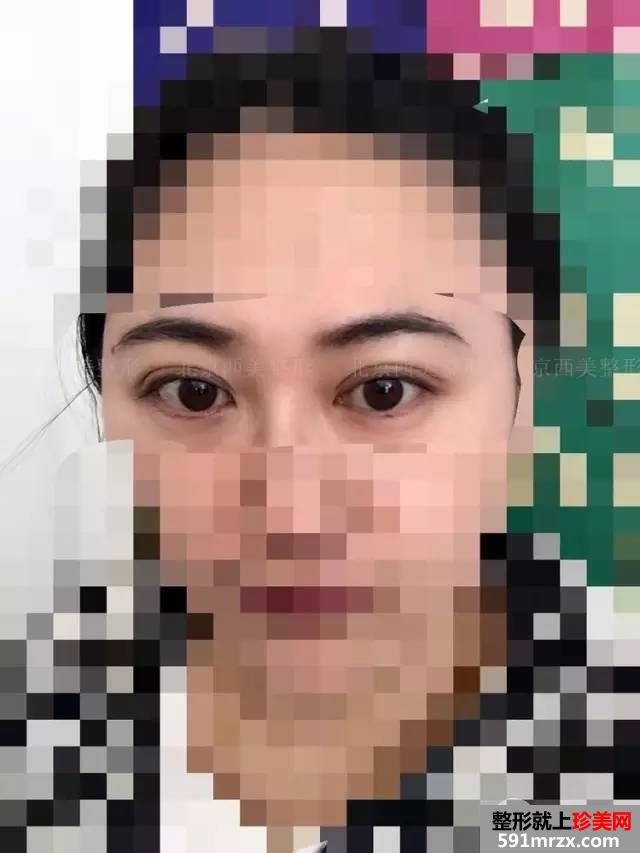 双眼皮恢复过程图 双眼皮手术前后对比照