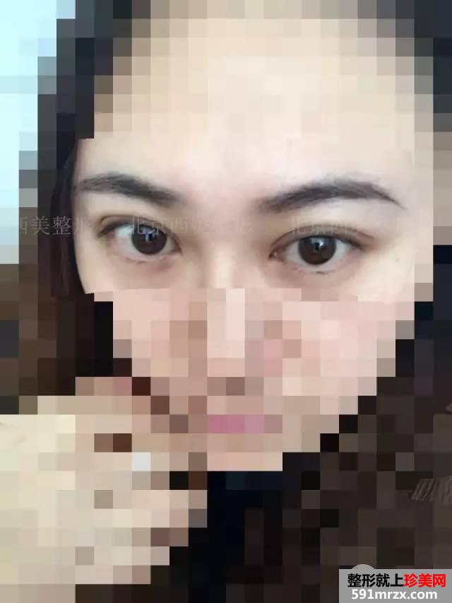 双眼皮恢复过程图 双眼皮手术前后对比照