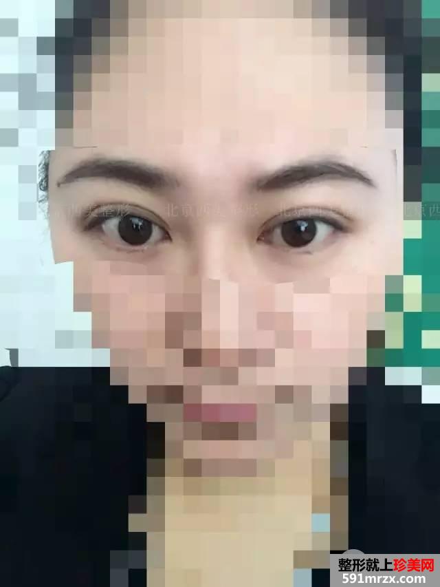 双眼皮恢复过程图 双眼皮手术前后对比照