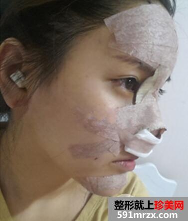 自体软骨鼻综合+面部脂肪填充恢复日记 前后对比照片