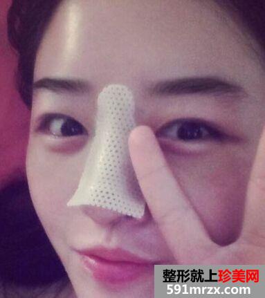 三个月效果鼻子变挺了，假体隆鼻案例图片