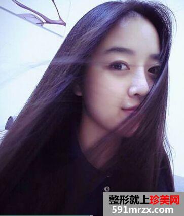 三个月效果鼻子变挺了，假体隆鼻案例图片