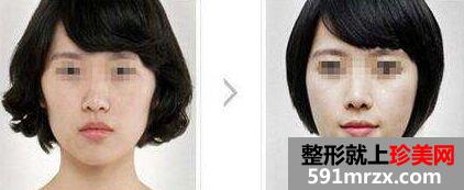 上海做颧骨整形手术价格贵吗、需要多少钱