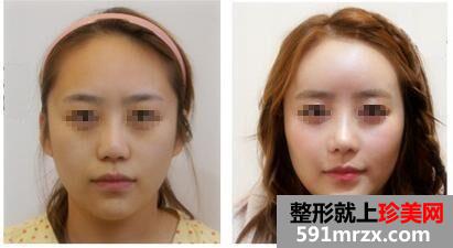 东莞脂自体肪填充要多少钱、脂肪填充最新价格曝光