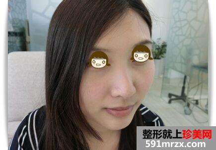 一个午休时间就做了三项微整形 变得美美哒!