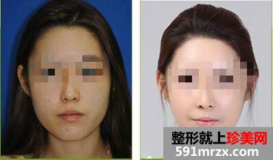 湛江下颌角切除多少钱、下颌角整形价格
