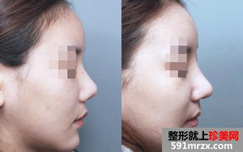 珠海假体隆鼻大概多少钱、假体隆鼻贵不贵
