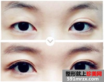 桂林双眼皮修复多少钱、双眼皮失败修复价格贵吗