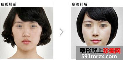 青岛瘦脸针多少钱一针、瘦脸针价格贵吗